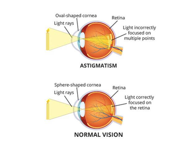 Astigmatism Causes Symptoms Bausch Lomb Astigmatism Causes Symptoms Bausch Lomb